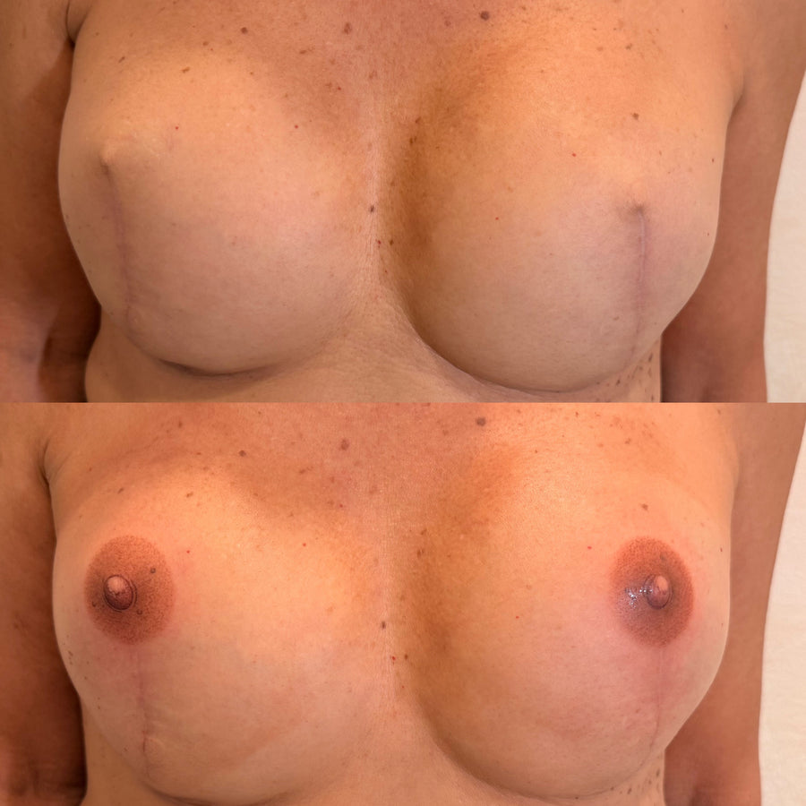 3D Areola Restoration