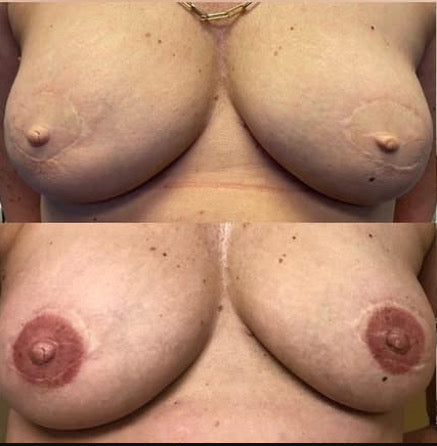 Bilateral