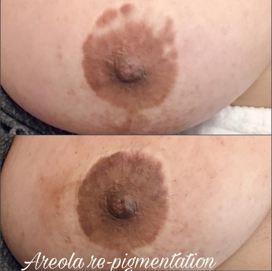 Areola Repigmentation