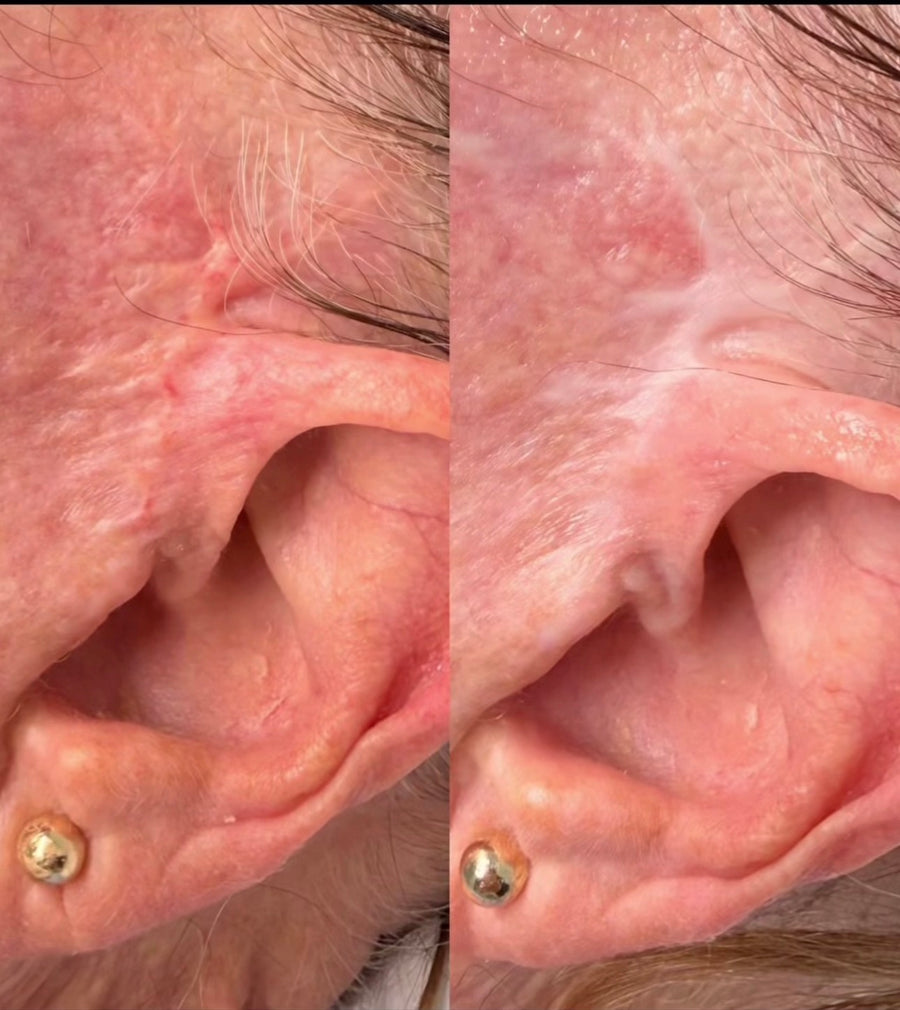 Facelift Scar