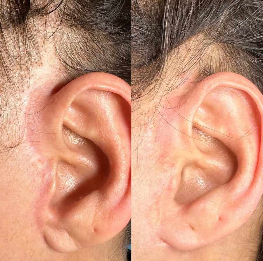 Ear Scar Camouflage