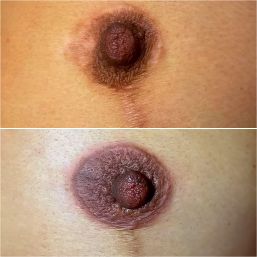 After Breast Lift