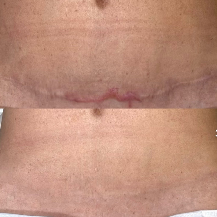 Abdominal Scar Camouflage