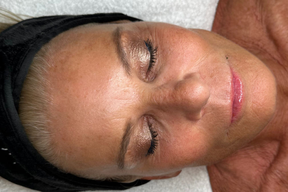 Before Platinum Hydrafacial facial treatment at GT LAB, Vero Beach with visible skin redness and texture.